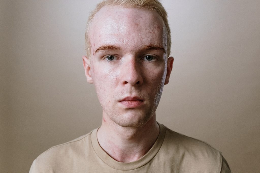 cicatrices-acne-clinica-guinova
