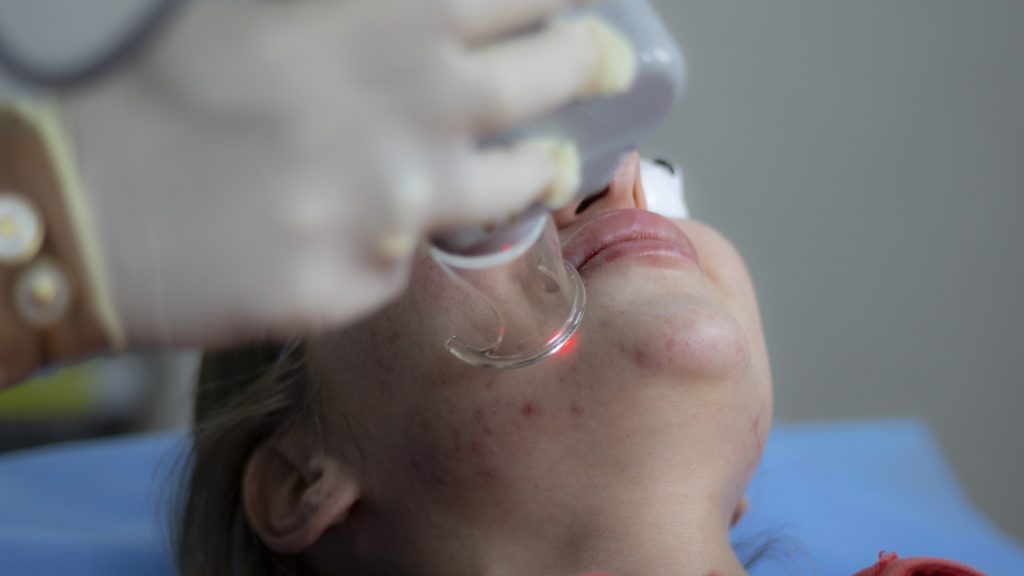 cicatrices-acne-tratamiento-clinica-guinova