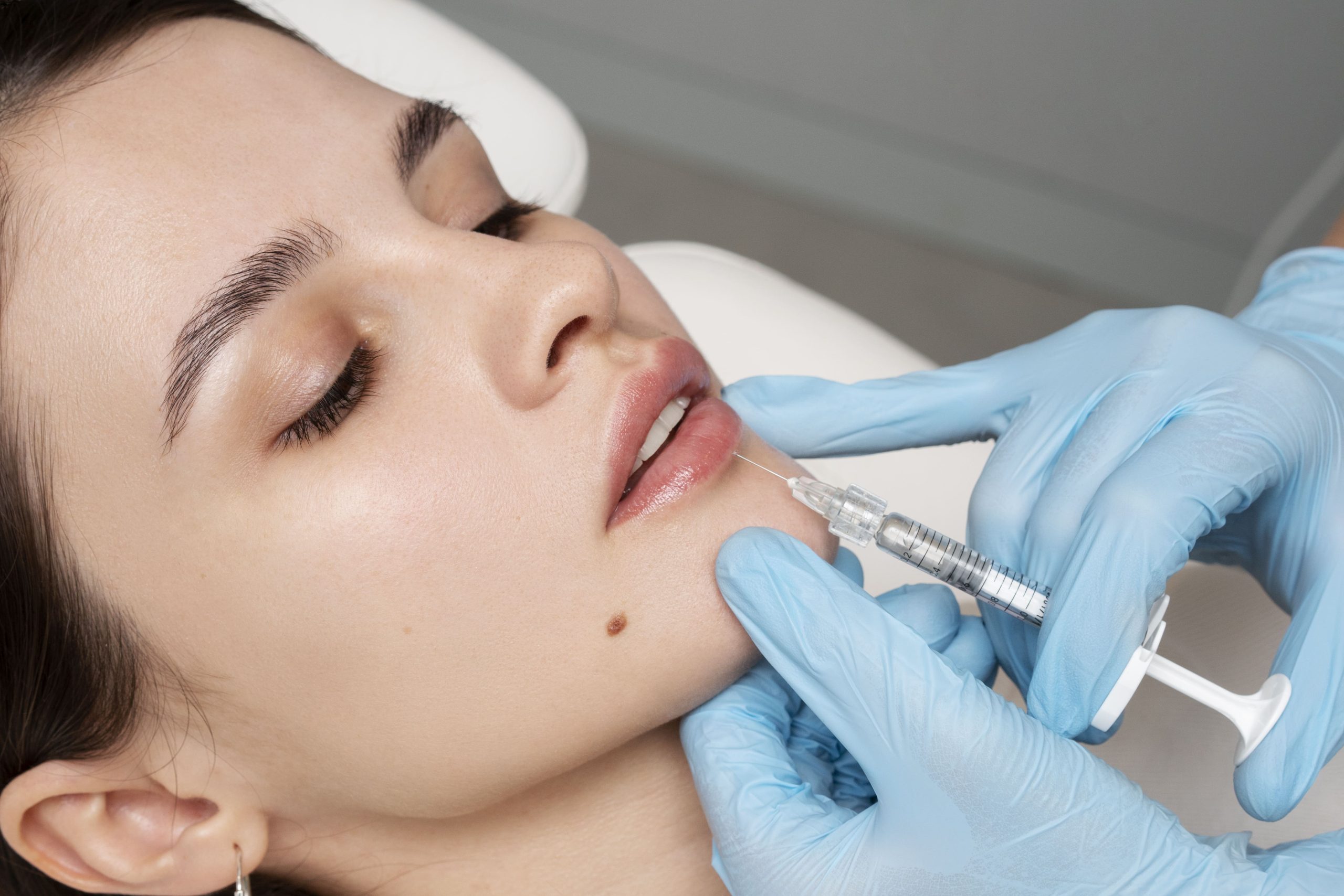 Aumento de labios con ácido hialurónico