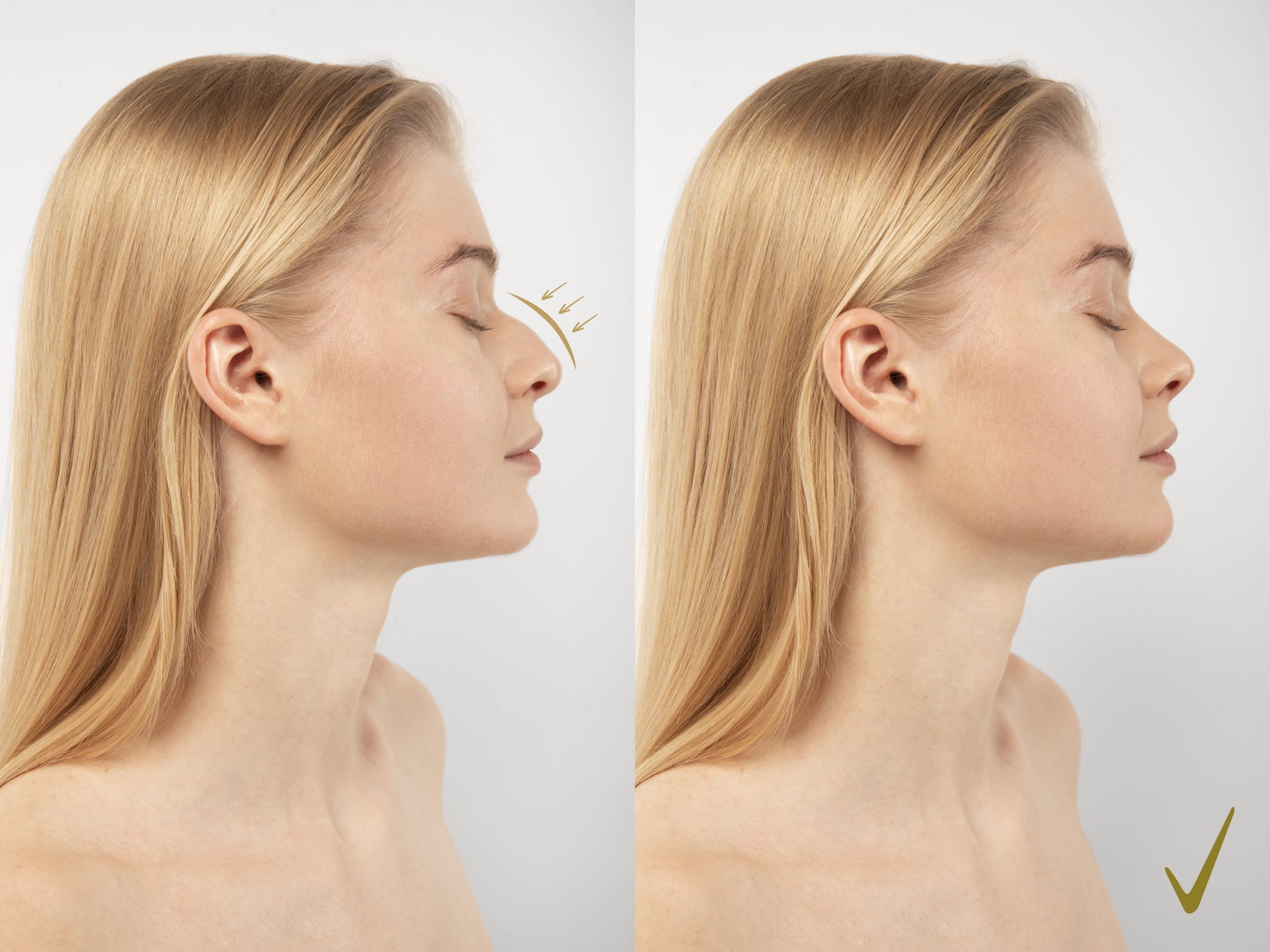 Rinomodelación: perfecciona tu perfil sin cirugía